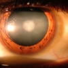 An eye with a cataract in the lens