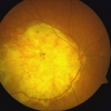 Auch Atrophie (Auflösung der Netzhaut und Aderhaut) verursacht eine AMD mit Sehbehinderung.