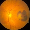 Choroidale Neovaskualisierung (abnorme Blutgefäße die sich hinter der Netzhaut ausbilden) verursachen eine AMD mit Sehbehinderung.