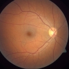 De macula is het centrale deel van de retina (netvlies), een dunne laag weefsel die de binnenrand van het oog bedekt en welke essentieel is om te kunnen zien.