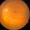 Pigmentary changes at the macula are a risk factor for AMD