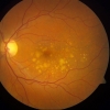Photograph of the fundus, the back of the eye. Soft drusen, the yellow-white deposits in the centre of the retina, are a proven risk factor for AMD
